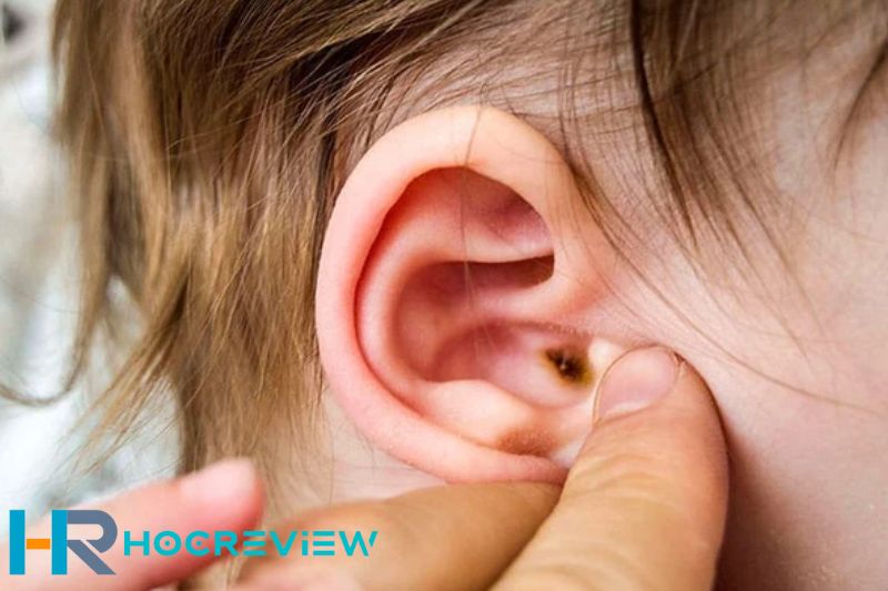 Đeo tai nghe gây Gây nhiễm trùng tai