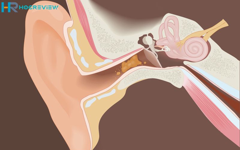 Tích tụ nhiều ráy tai, dẫn đến việc ù tai, giảm khả năng nghe